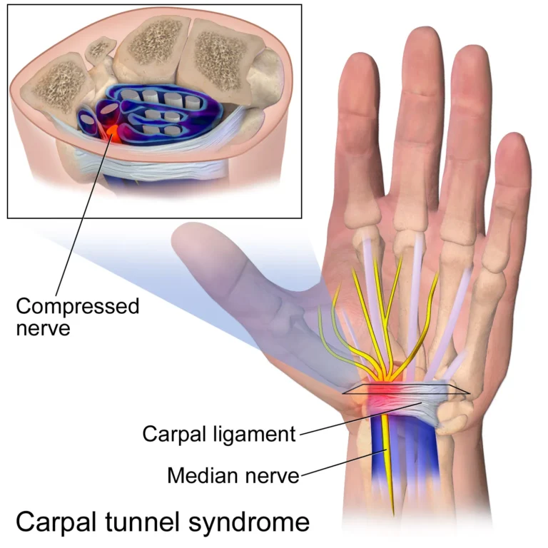 Carpal Tunnel Release Treatment in Indore, orthopedic doctor in Indore