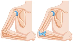 Elbow Replacement Surgery in Indore