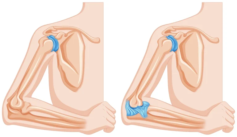Elbow Replacement Surgery in Indore